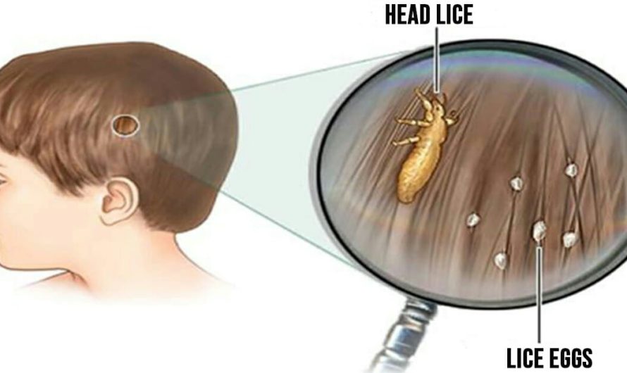 Head lice: How to get rid of them and stop them coming back