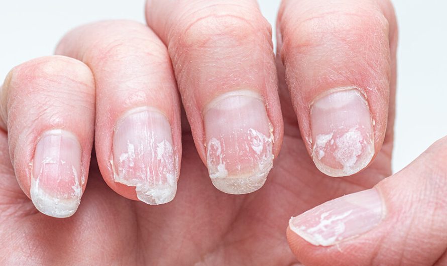 Rippled fingernails reveal secrets of possible disease