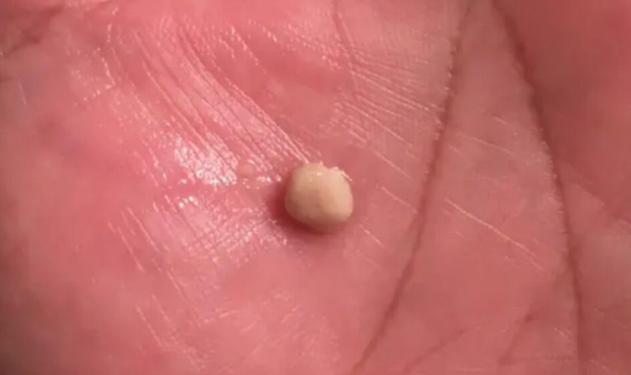 Here’s what you need to know about tonsil stones – the weird pimple-like growths in your throat