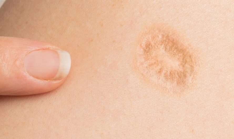 Smallpox vaccine scars: What they look like and why